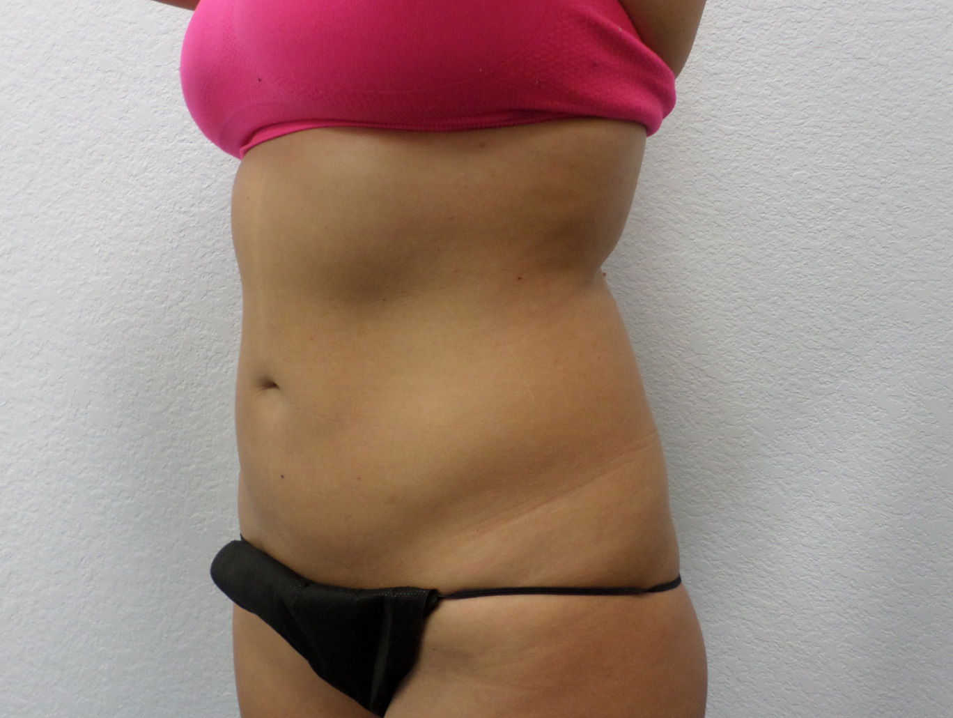 Case BD-2743 after photo