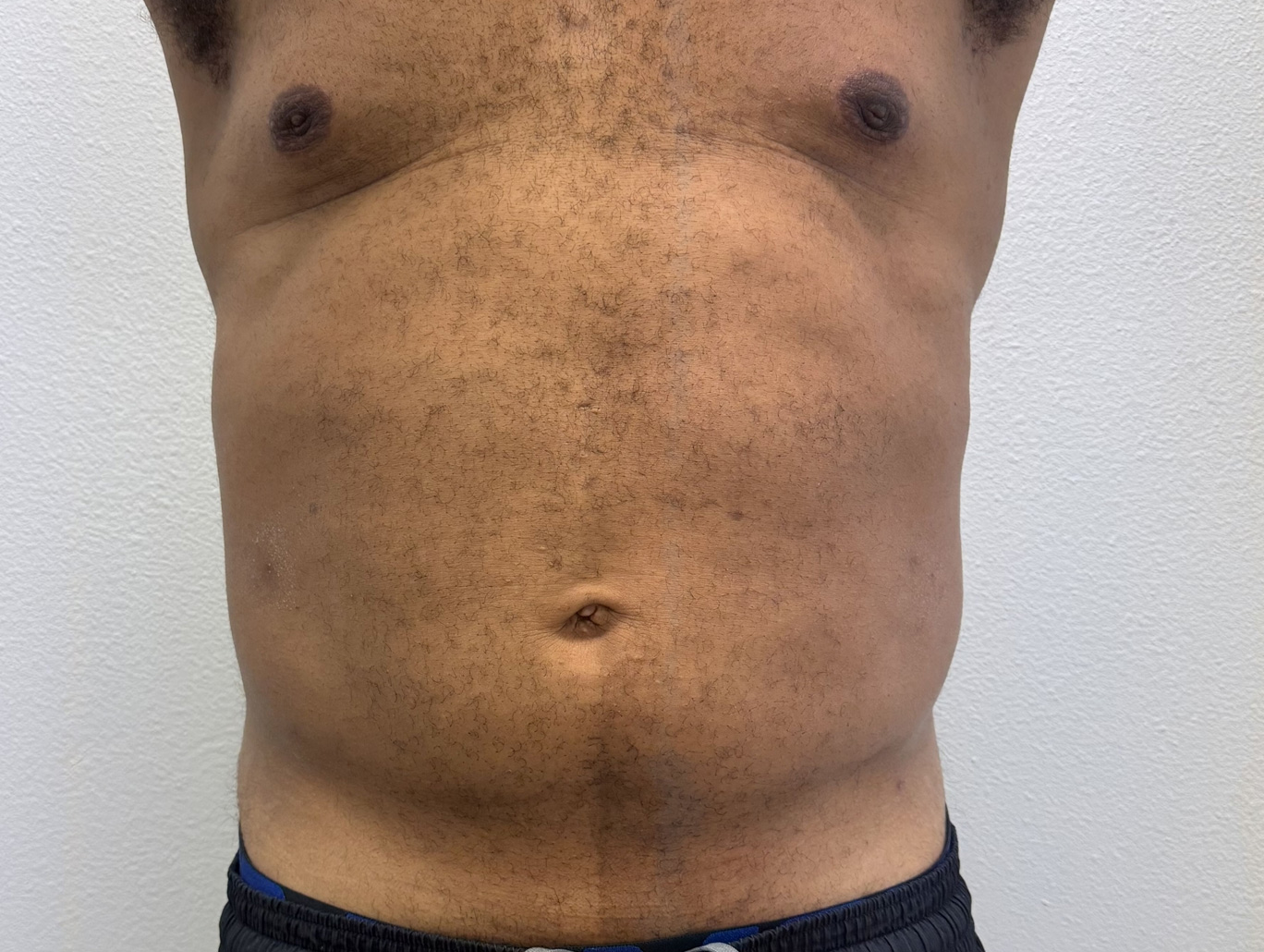 Case BD-2862 after photo