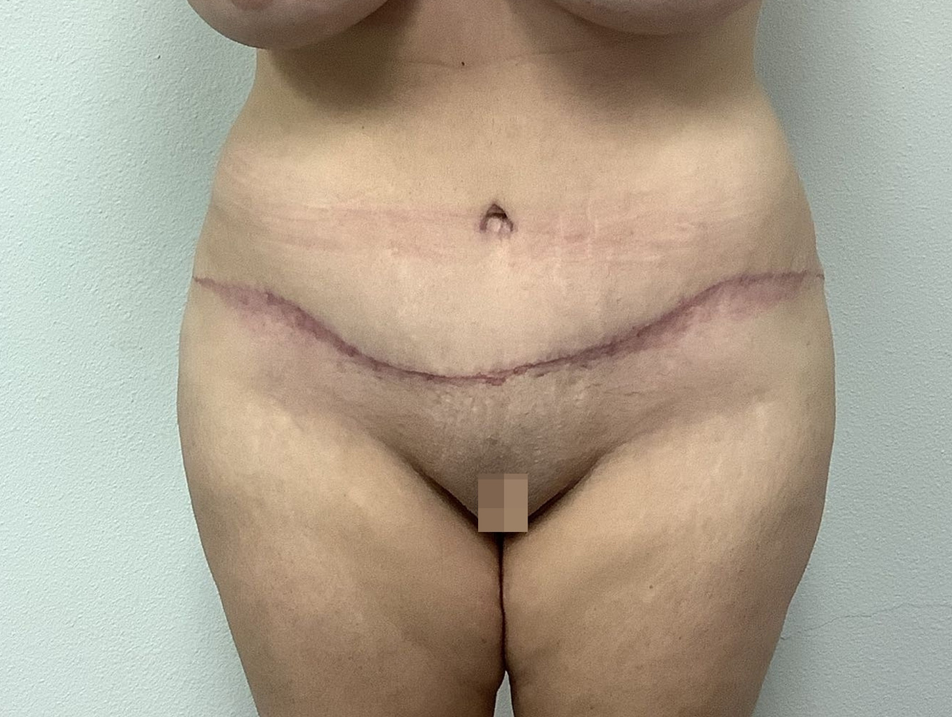 Case BD-1883 after photo