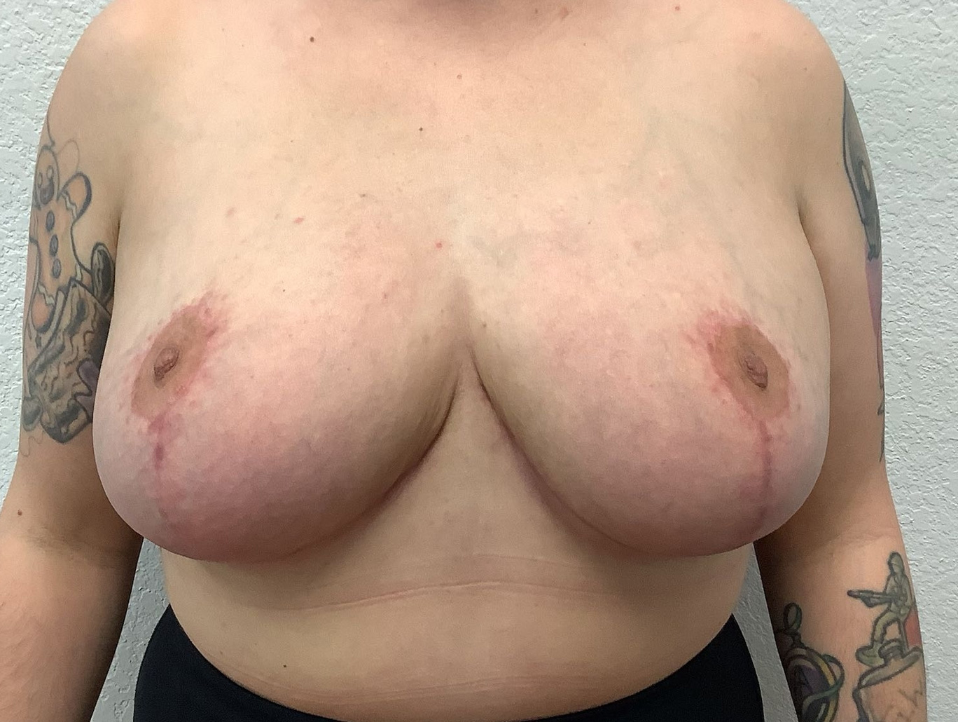 Case BR-6769 after photo