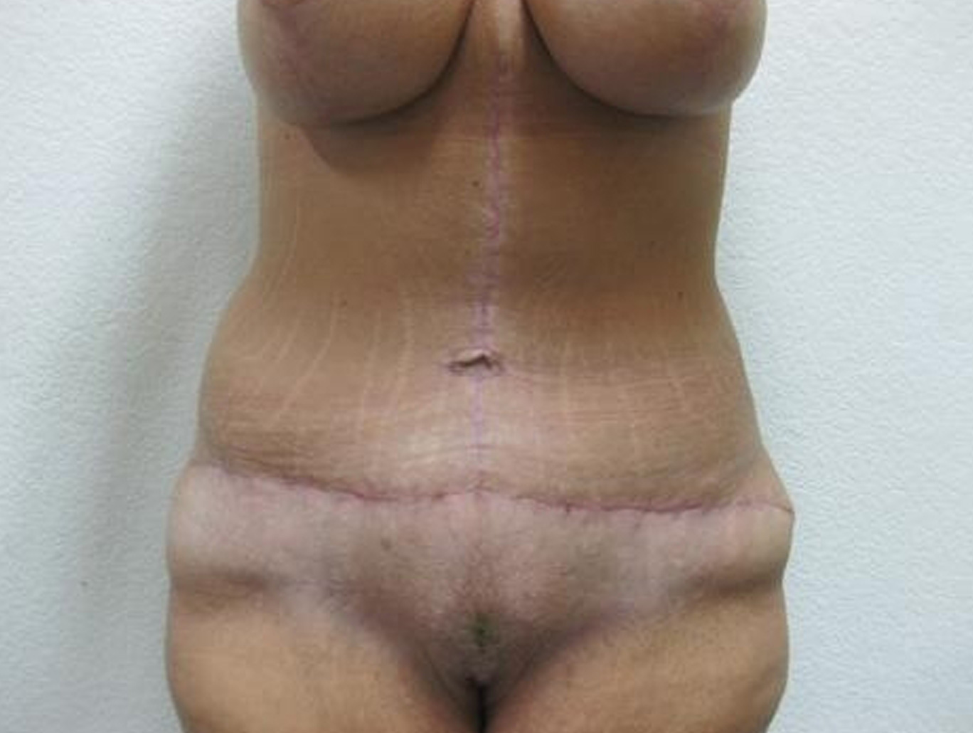 Case BD-7363 after photo