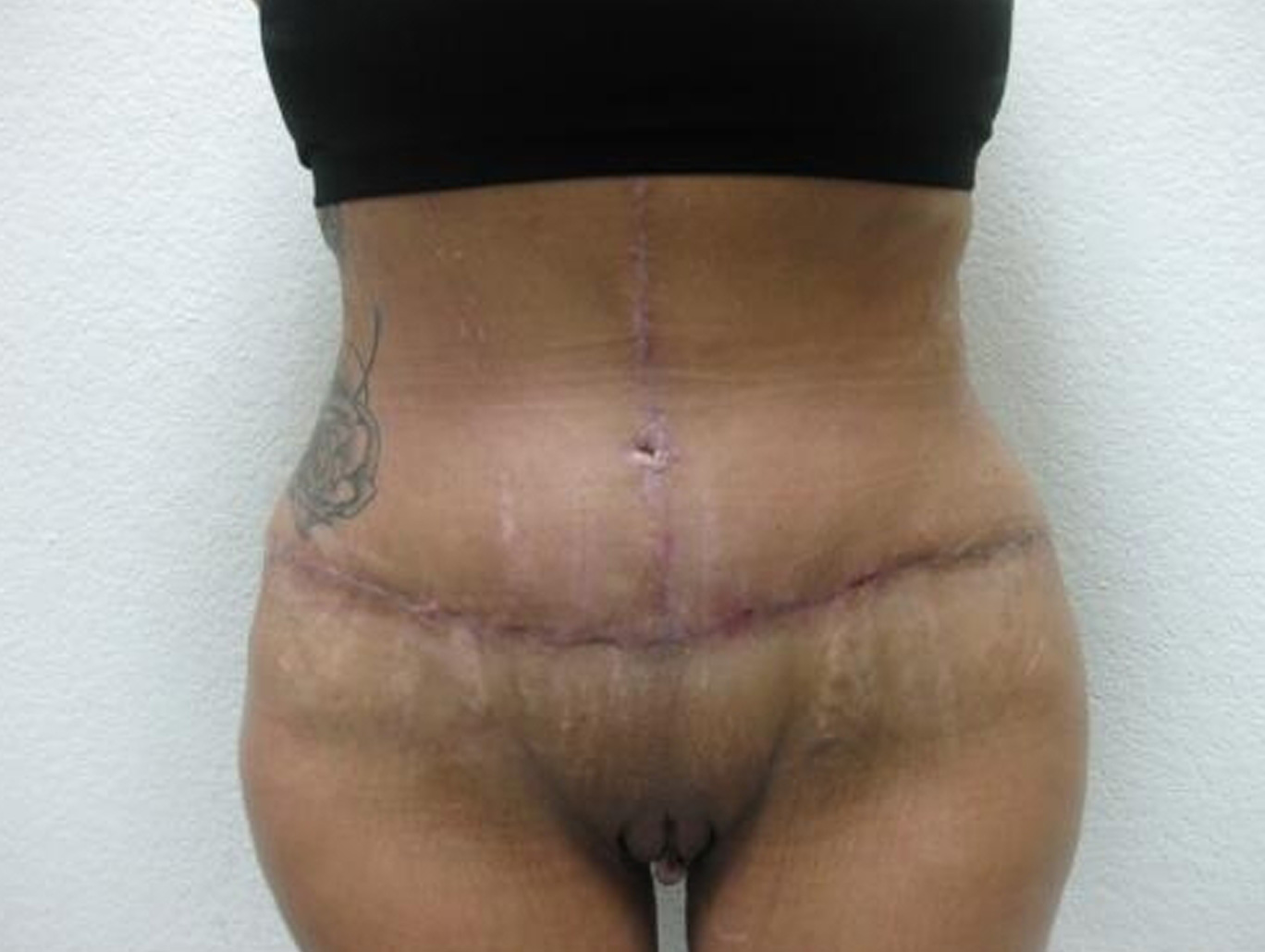 Case BD-7614 after photo