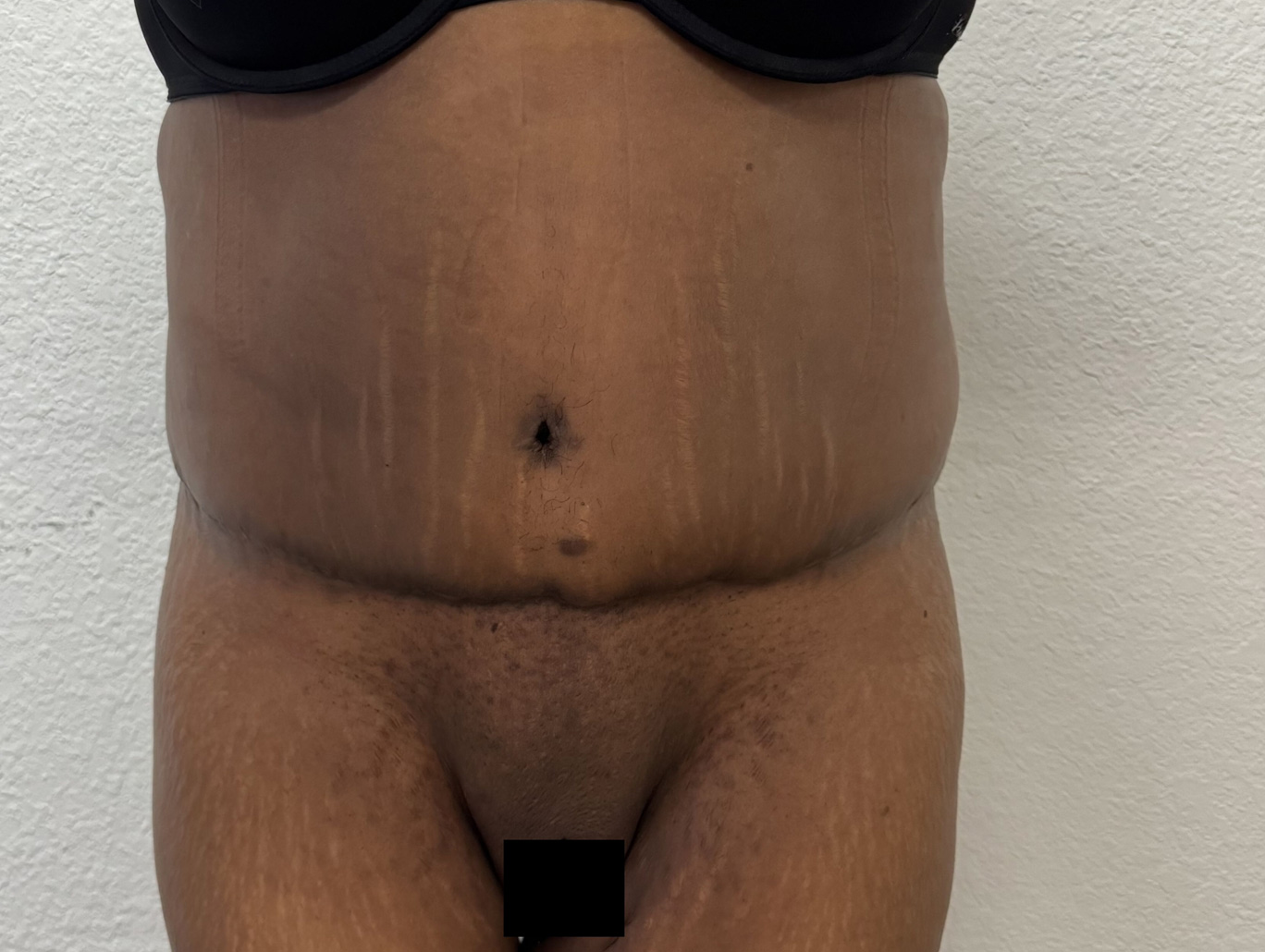 Case BD-7474 after photo