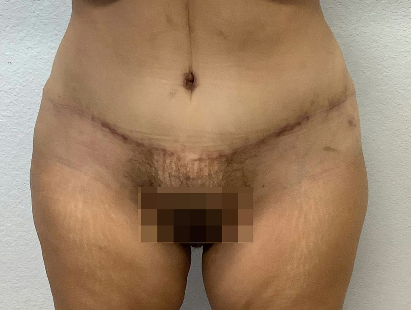 Case BD-7491 after photo