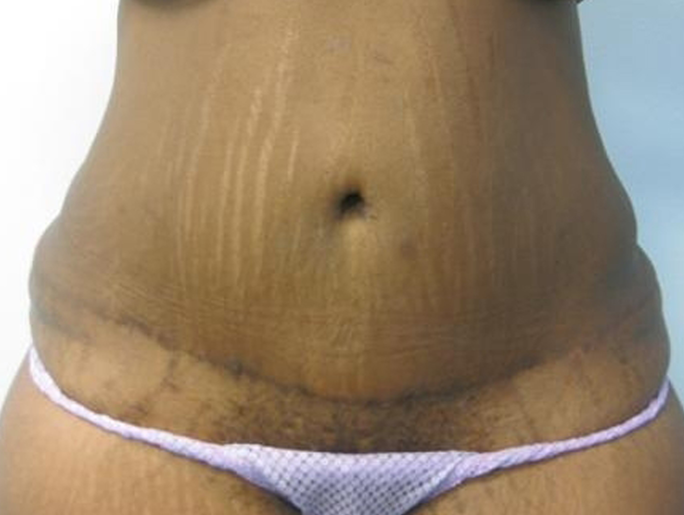Case BD-7451 after photo
