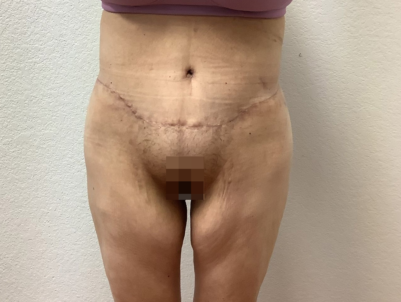 Case BD-7032 after photo