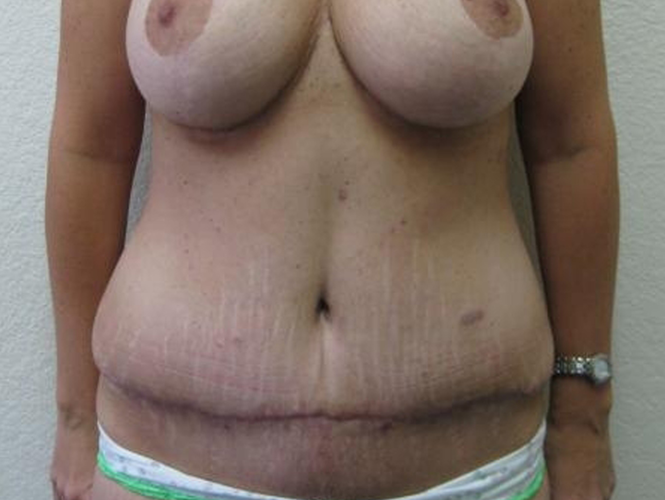 Case BD-7369 after photo