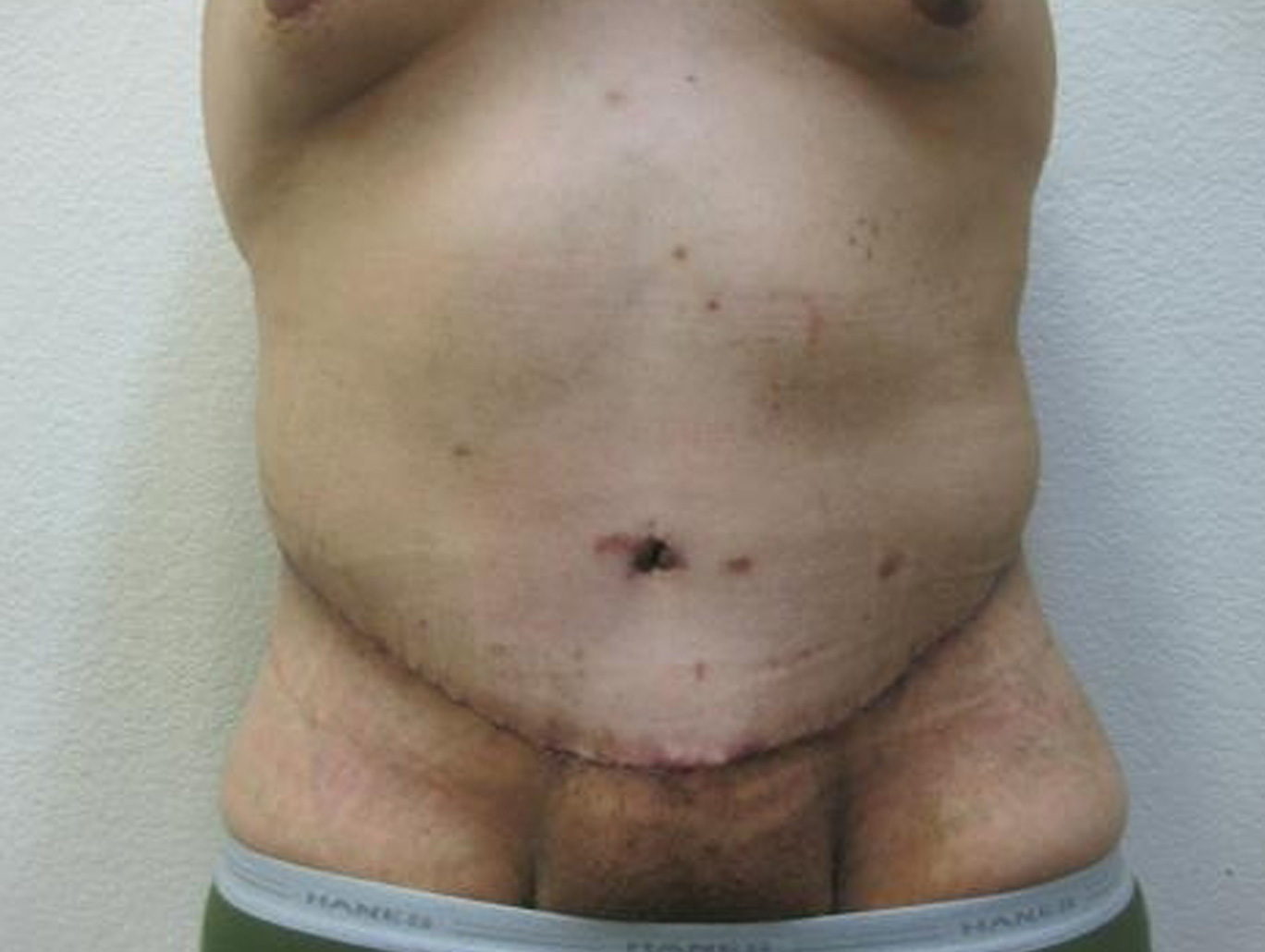 Case BD-7079 after photo