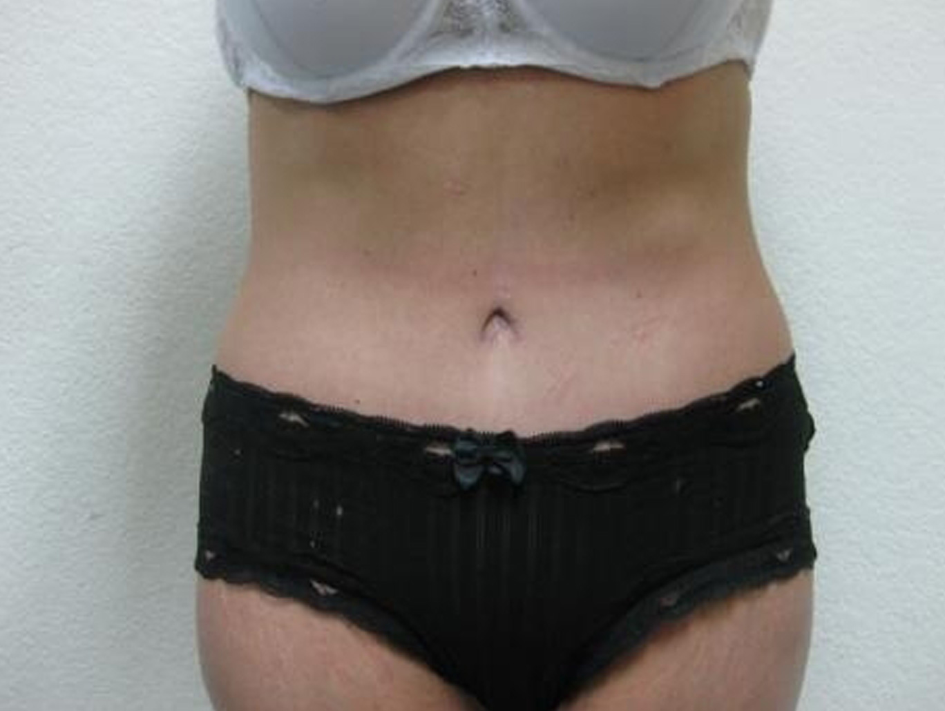 Case BD-7742 after photo