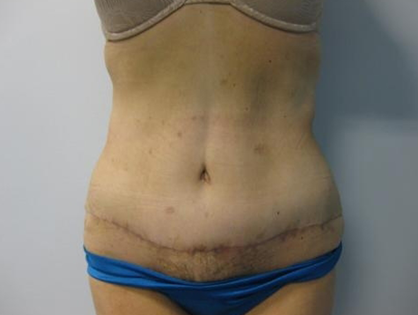 Case BD-7331 after photo