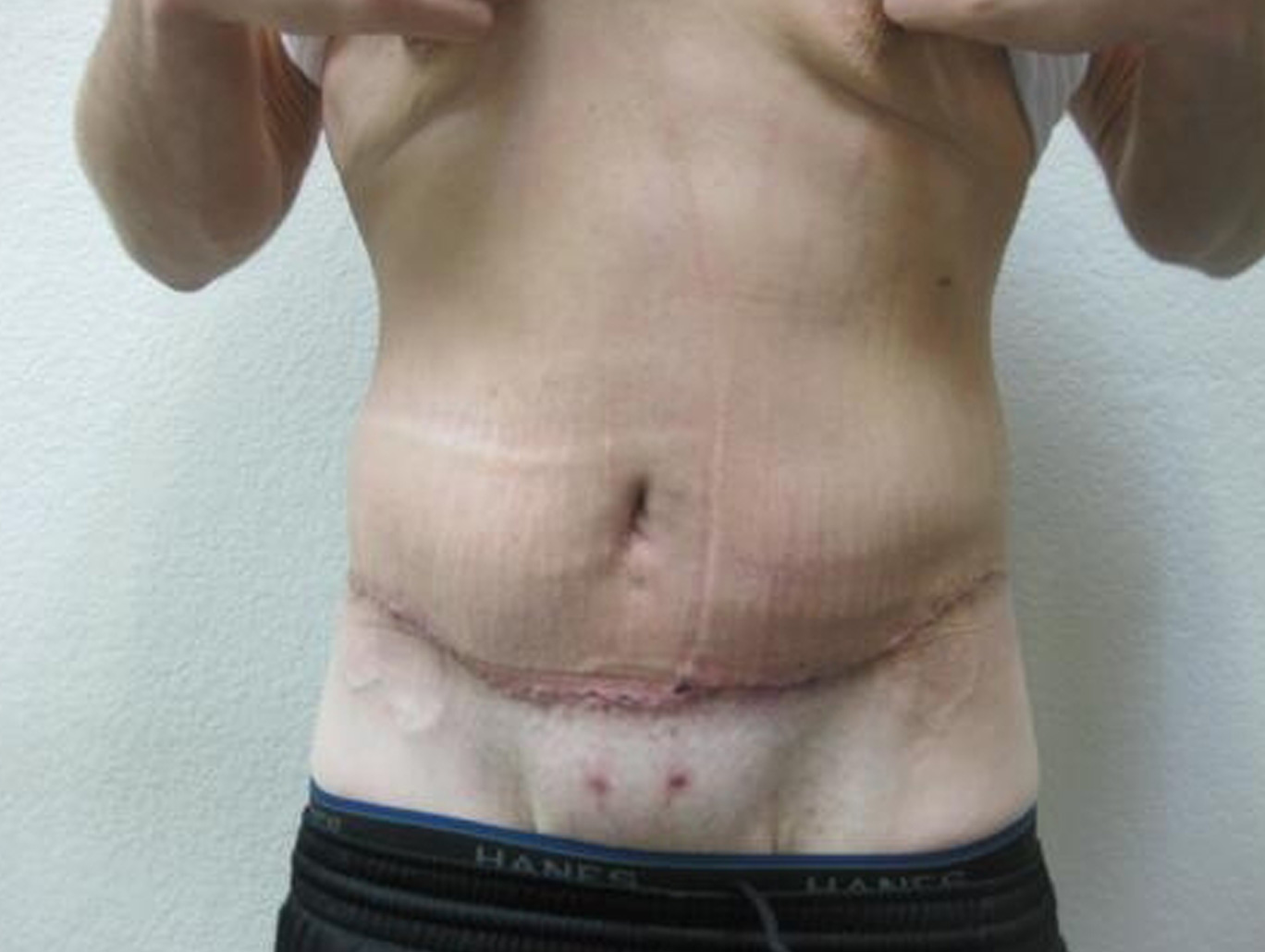 Case BD-7625 after photo