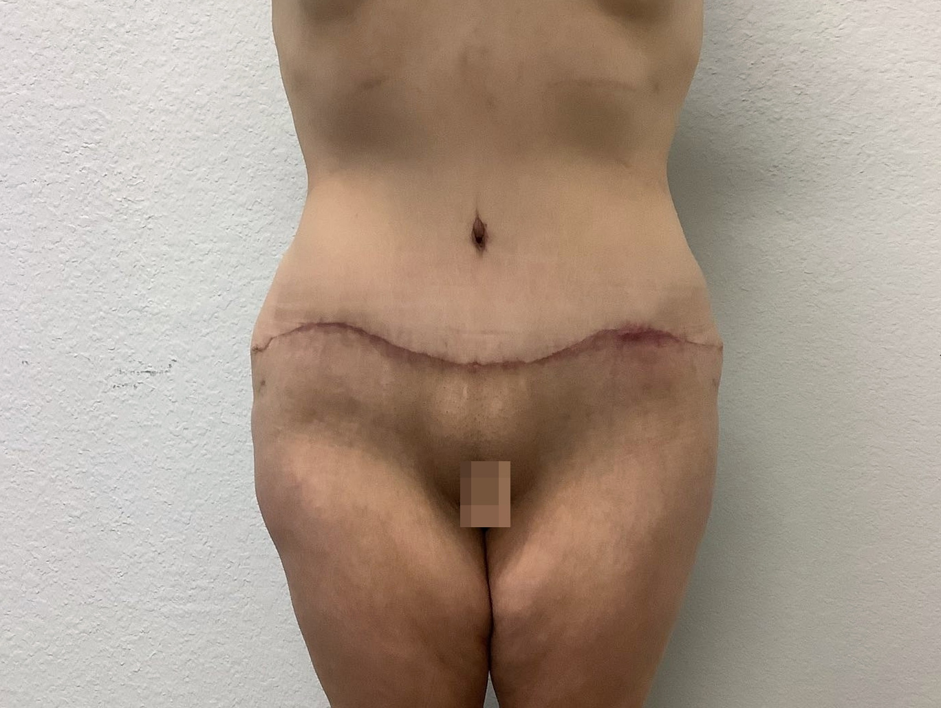Case BD-7466 after photo