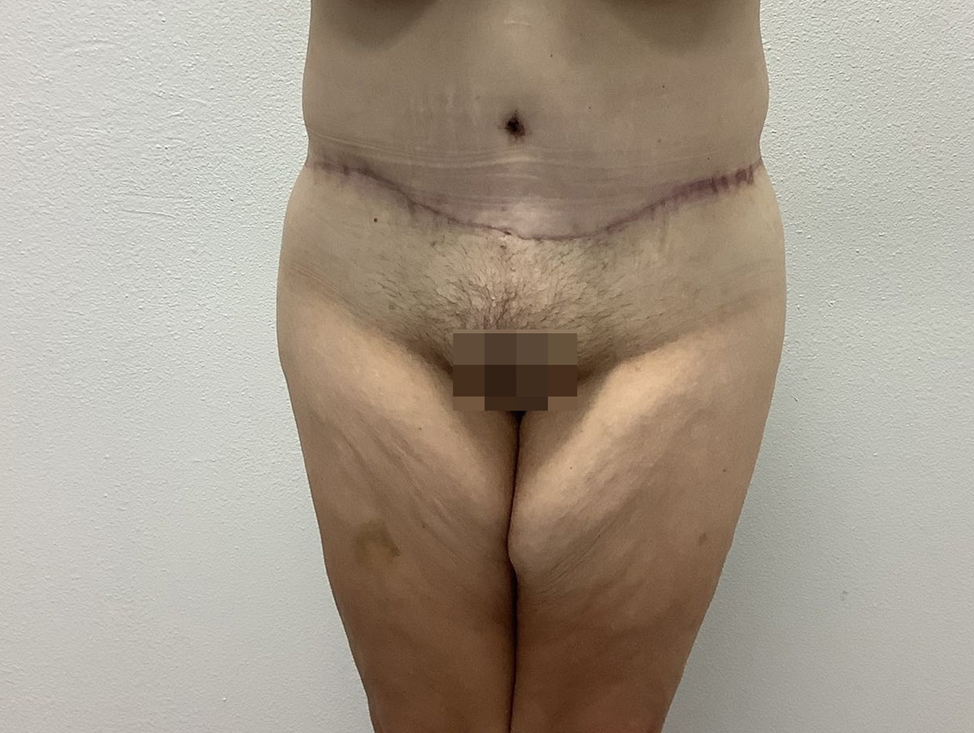 Case BD-7353 after photo
