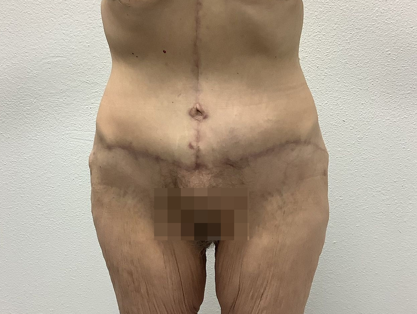 Case BD-7692 after photo