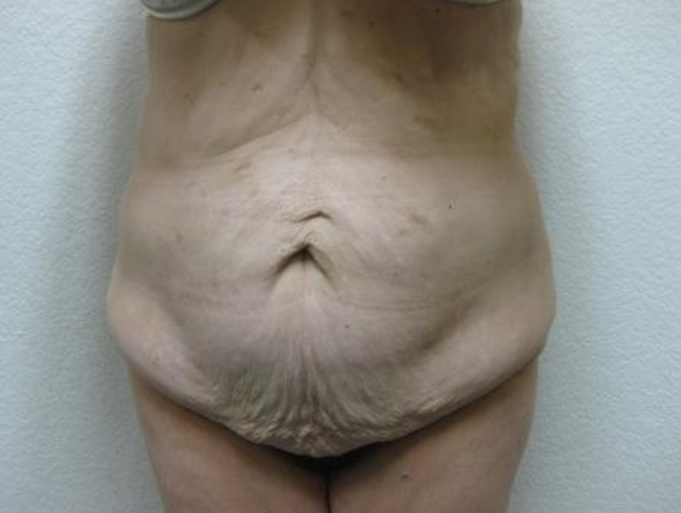 Case BD-7331 before photo