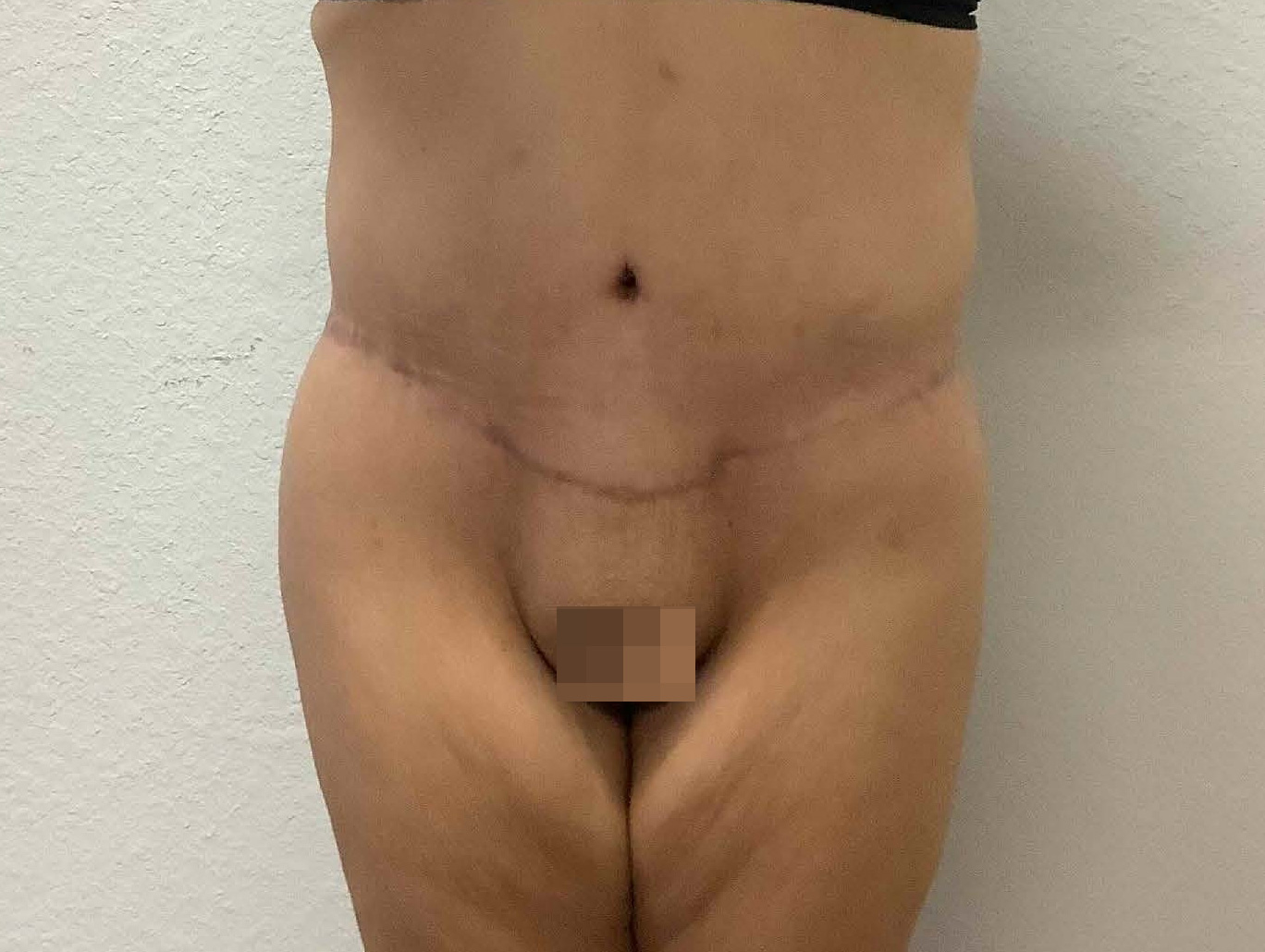 Case BD-7139 after photo
