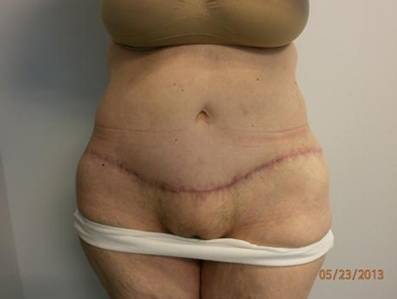Case BD-7925 after photo