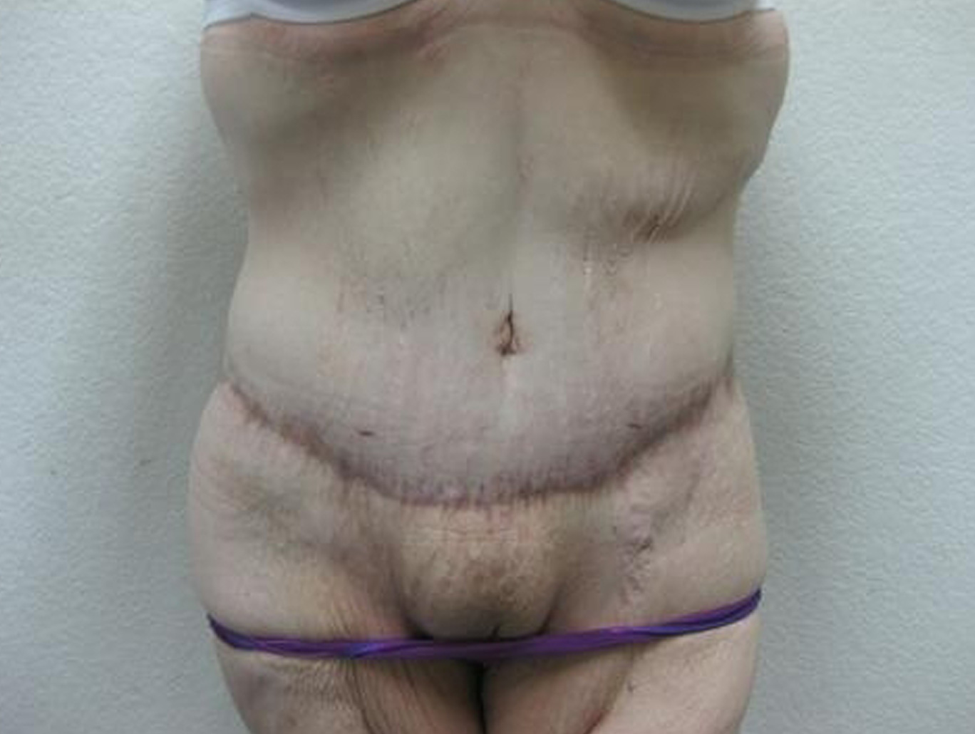 Case BD-7528 after photo