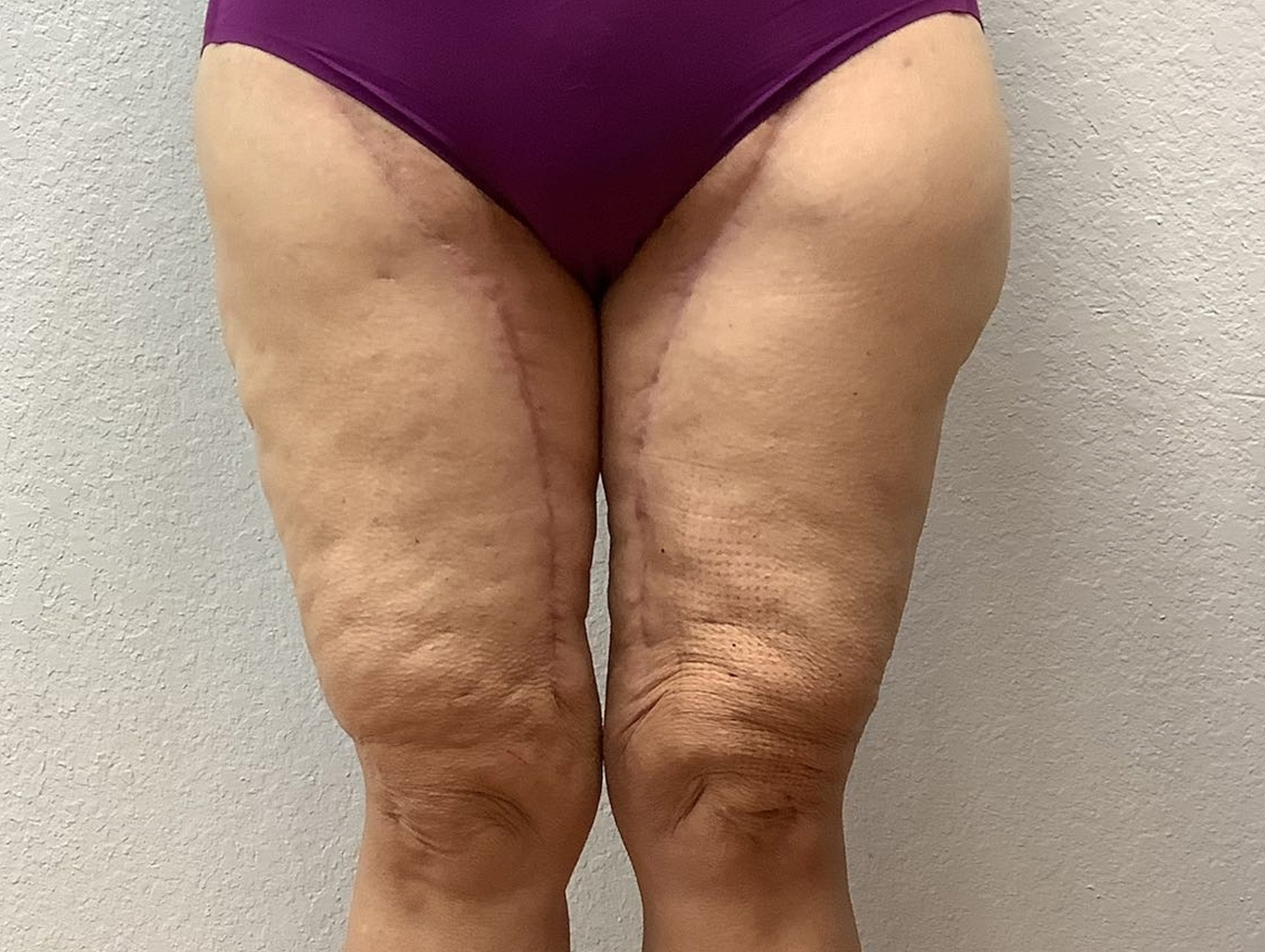 Case BD-6397 after photo